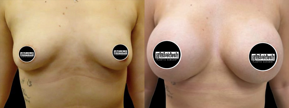 Breast Augmentation Before & After Photos | Rottman Plastic Surgery