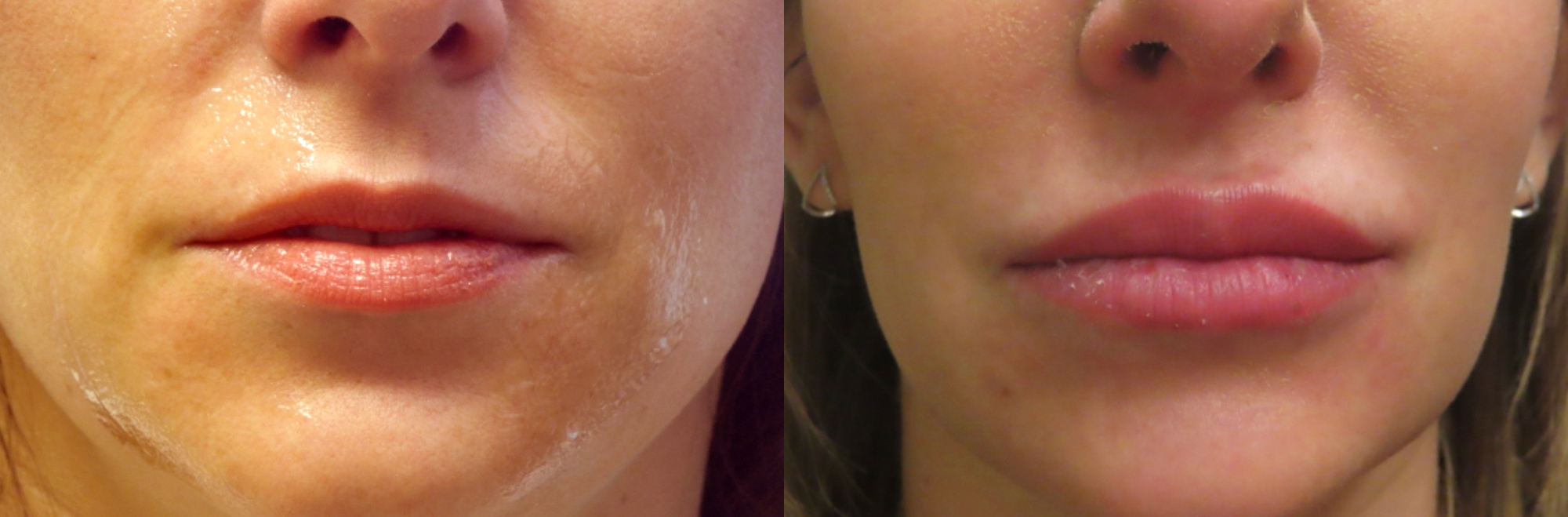 Injectables And Dermal Fillers Before & After Photos | Rottman Plastic Surgery