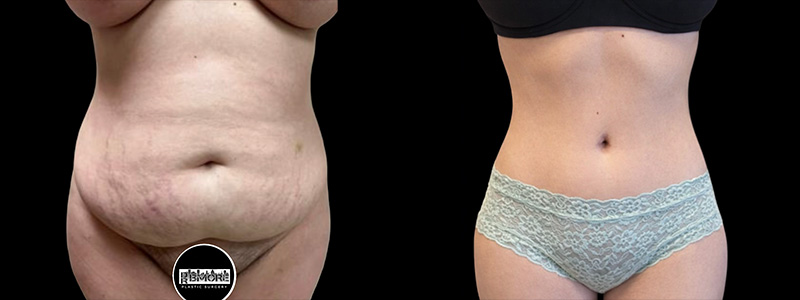 Mini Tuck And Tummy Tuck (abdominoplasty) Before & After Photos | Rottman Plastic Surgery