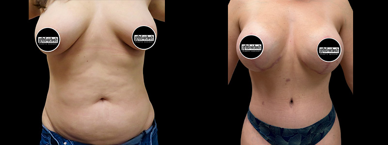 Mommy Makeover Before & After Photos | Rottman Plastic Surgery