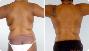 Liposuction Before and After Pictures Baltimore, MD
