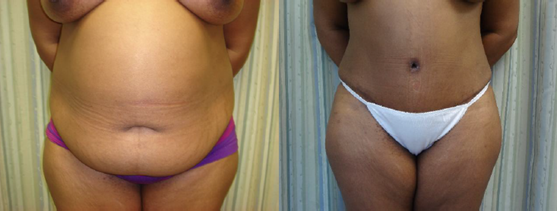 Liposuction Before and After Pictures Baltimore, MD