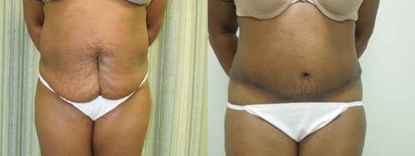 Liposuction Before and After Pictures Baltimore, MD