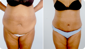 Mini Tuck and Tummy Tuck Before and After Pictures Baltimore, MD