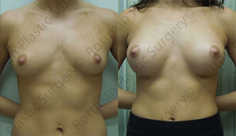 Before and After Breast Augmentation in Maryland