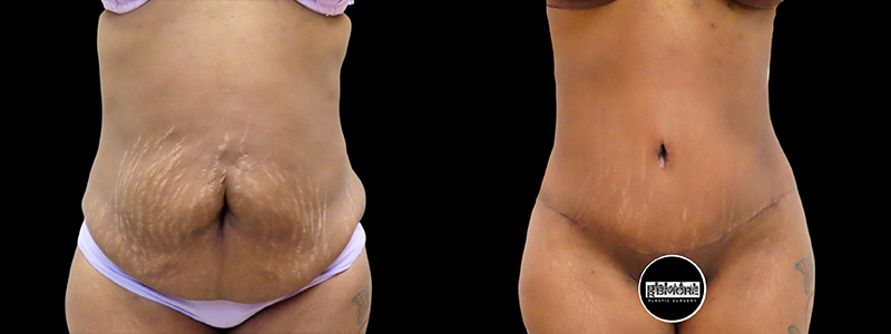Body Lift Before & After Photos | Rottman Plastic Surgery