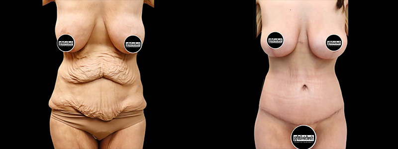 Body Lift Before & After Photos | Rottman Plastic Surgery