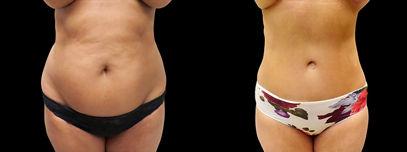 Body Lift Before & After Photos | Rottman Plastic Surgery