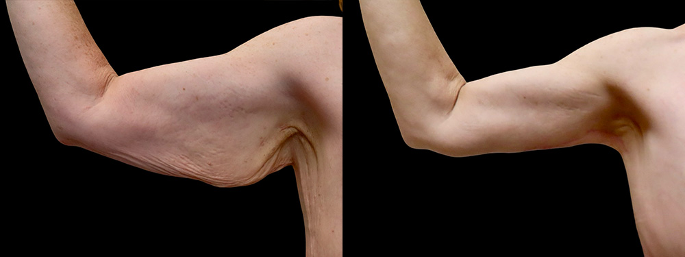 Brachioplasty Before & After Photos | Rottman Plastic Surgery