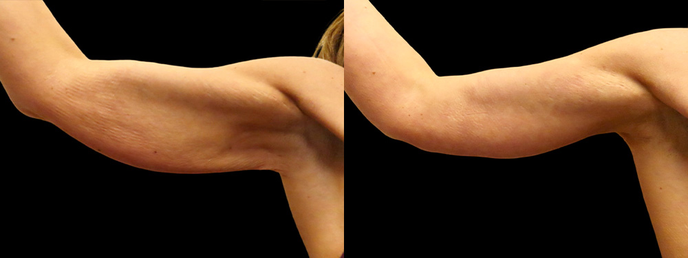 Brachioplasty Before & After Photos | Rottman Plastic Surgery