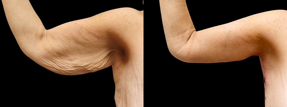 Brachioplasty Before & After Photos | Rottman Plastic Surgery