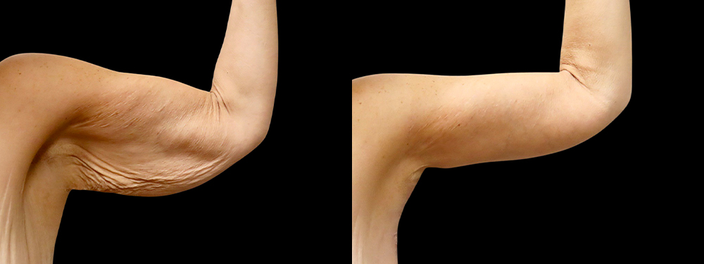 Brachioplasty Before & After Photos | Rottman Plastic Surgery