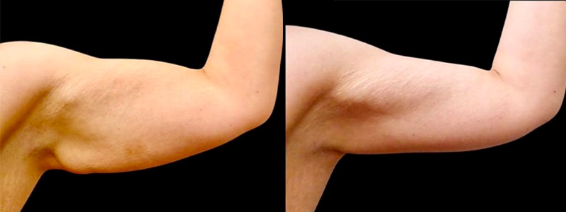 Brachioplasty Before & After Photos | Rottman Plastic Surgery