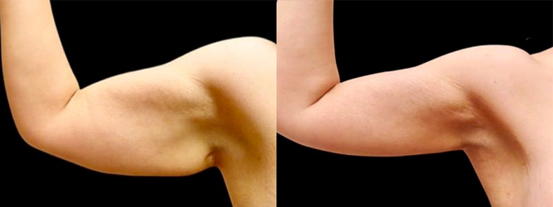 Brachioplasty Before & After Photos | Rottman Plastic Surgery