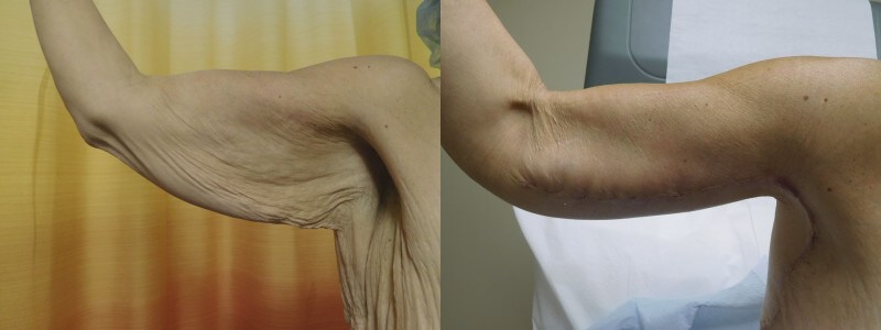 Brachioplasty Before & After Photos | Rottman Plastic Surgery