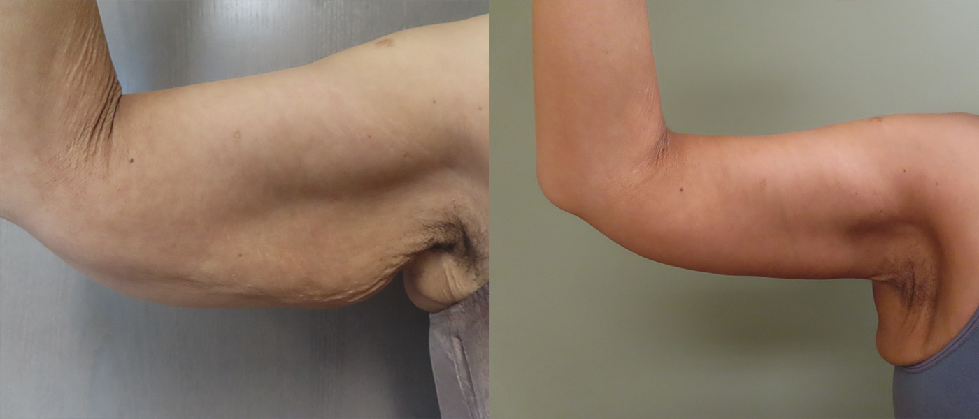 Brachioplasty Before & After Photos | Rottman Plastic Surgery