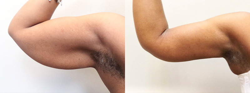 Brachioplasty Before & After Photos | Rottman Plastic Surgery