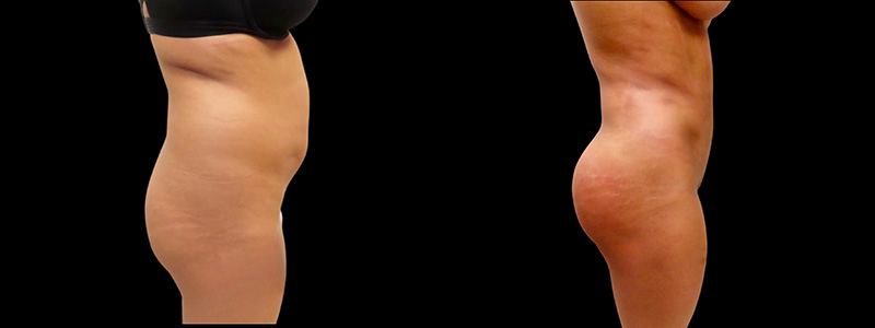 Brazilian Butt Lift Before & After Photos | Rottman Plastic Surgery