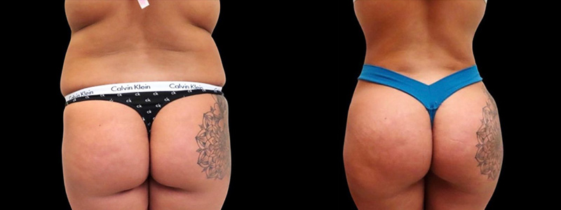 Brazilian Butt Lift Before & After Photos | Rottman Plastic Surgery