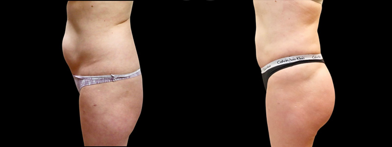 Brazilian Butt Lift Before & After Photos | Rottman Plastic Surgery