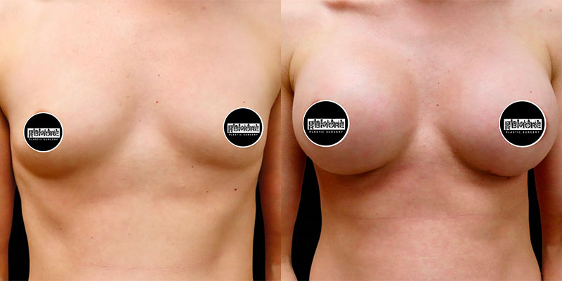 Breast Augmentation Before & After Photos | Rottman Plastic Surgery