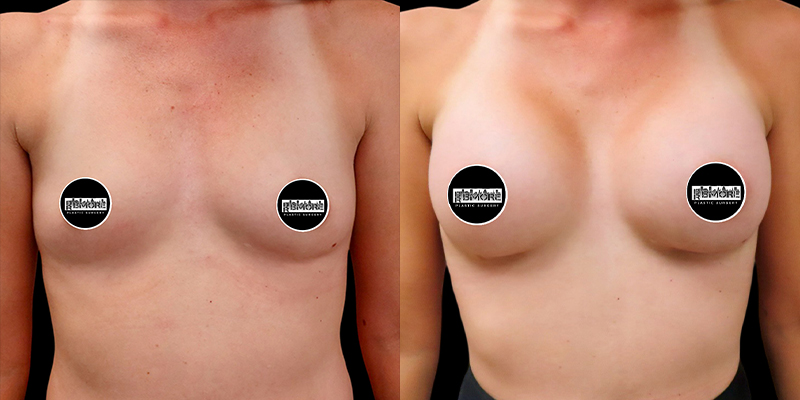 Breast Augmentation Before & After Photos | Rottman Plastic Surgery