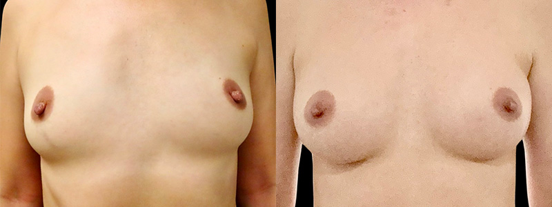 Breast Augmentation Before & After Photos | Rottman Plastic Surgery