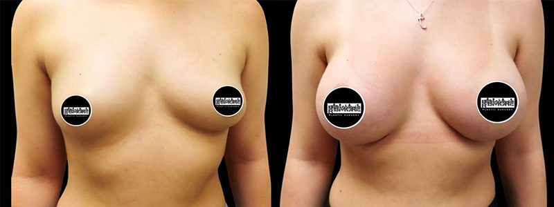 Breast Augmentation Before & After Photos | Rottman Plastic Surgery