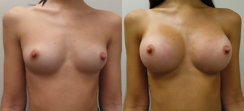 Breast Augmentation Before & After Photos | Rottman Plastic Surgery