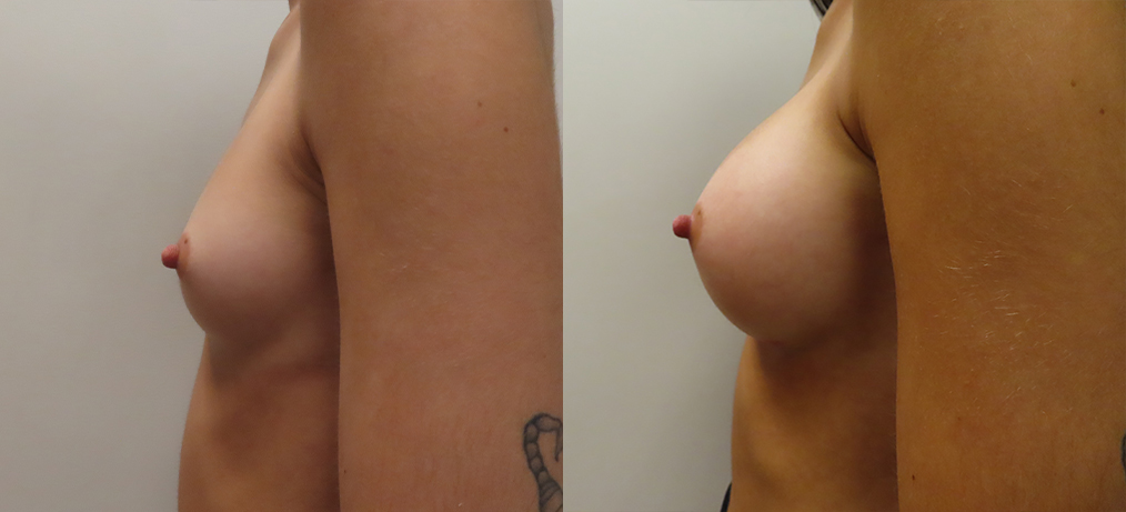 Breast Augmentation Before & After Photos | Rottman Plastic Surgery