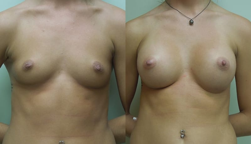 Breast Augmentation Before & After Photos | Rottman Plastic Surgery