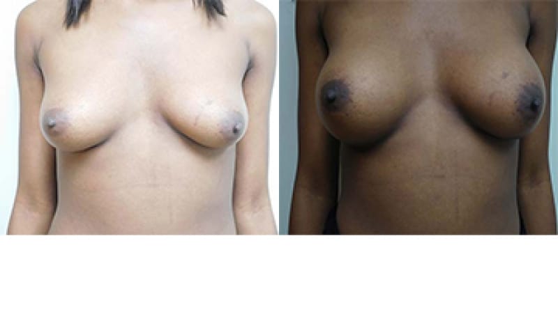 Breast Augmentation Before & After Photos | Rottman Plastic Surgery