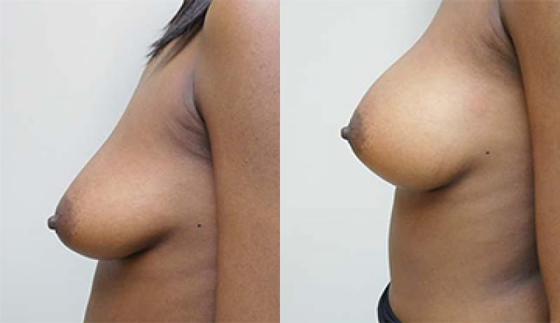 Breast Augmentation Before & After Photos | Rottman Plastic Surgery