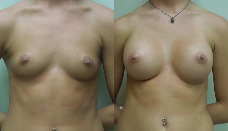 Breast Augmentation Before & After Photos | Rottman Plastic Surgery