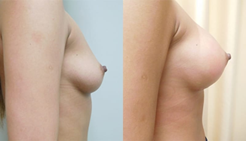 Breast Augmentation Before & After Photos | Rottman Plastic Surgery