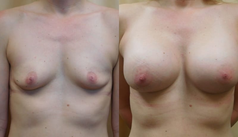 Breast Augmentation Before & After Photos | Rottman Plastic Surgery