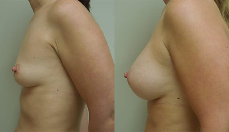 Breast Augmentation Before & After Photos | Rottman Plastic Surgery