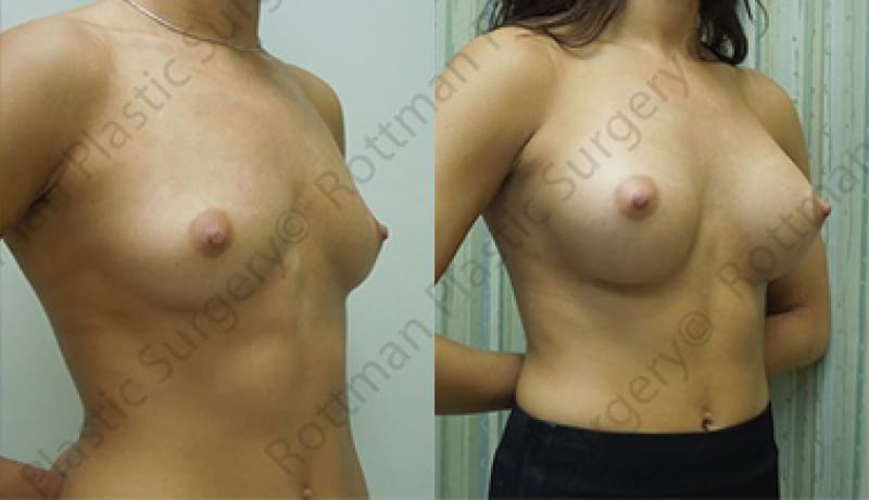 Breast Augmentation Before & After Photos | Rottman Plastic Surgery