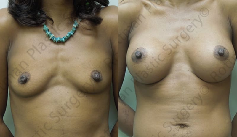 Breast Augmentation Before & After Photos | Rottman Plastic Surgery