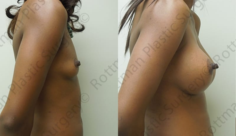 Breast Augmentation Before & After Photos | Rottman Plastic Surgery
