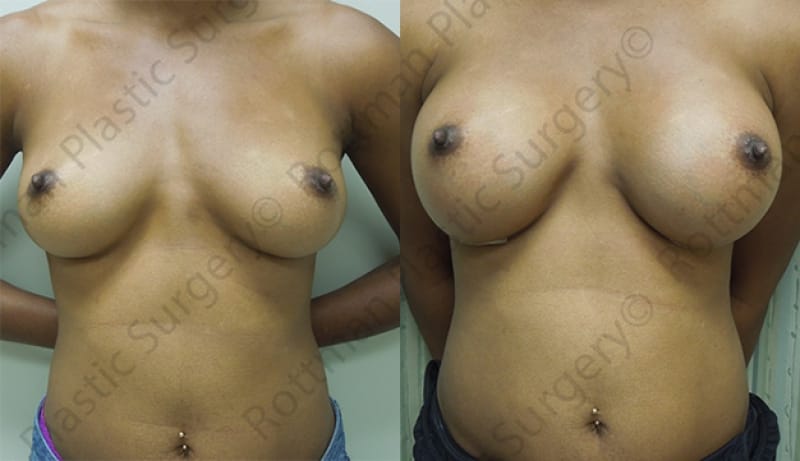 Breast Augmentation Before & After Photos | Rottman Plastic Surgery