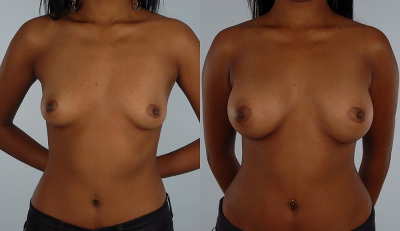 Breast Augmentation Before & After Photos | Rottman Plastic Surgery