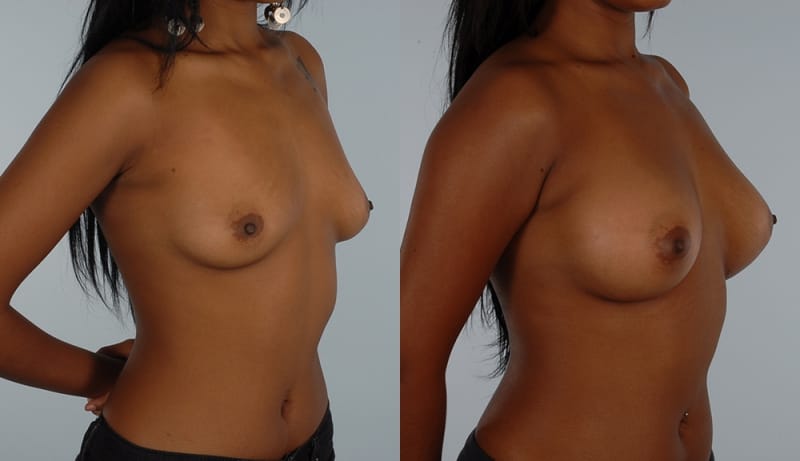 Breast Augmentation Before & After Photos | Rottman Plastic Surgery