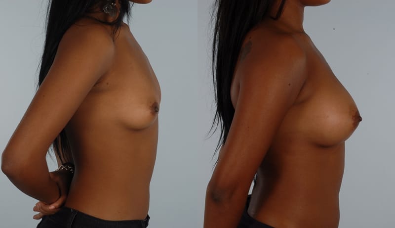Breast Augmentation Before & After Photos | Rottman Plastic Surgery