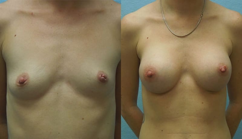 Breast Augmentation Before & After Photos | Rottman Plastic Surgery