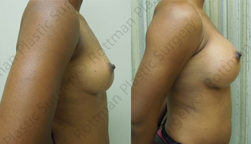 Breast Augmentation Before & After Photos | Rottman Plastic Surgery