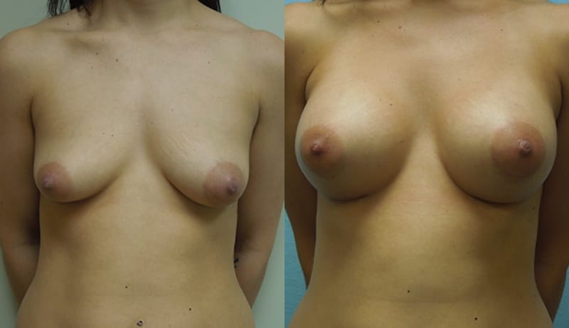 Breast Augmentation Before & After Photos | Rottman Plastic Surgery