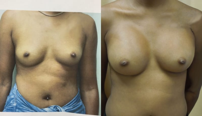 Breast Augmentation Before & After Photos | Rottman Plastic Surgery