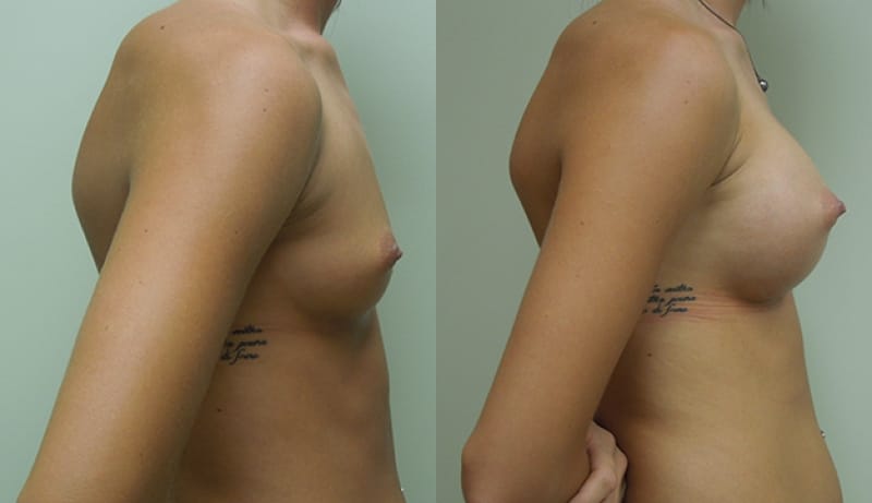 Breast Augmentation Before & After Photos | Rottman Plastic Surgery