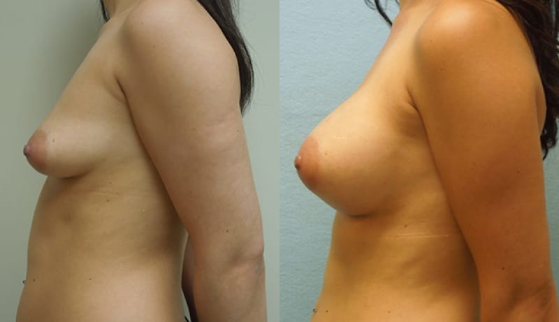 Breast Augmentation Before & After Photos | Rottman Plastic Surgery